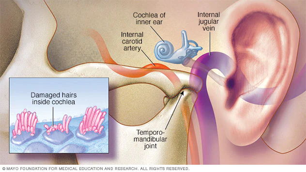 Penyakit Tinnitus: Mengenal Penyebab dan Langkah-langkah Mencegah Telinga Berdenging
